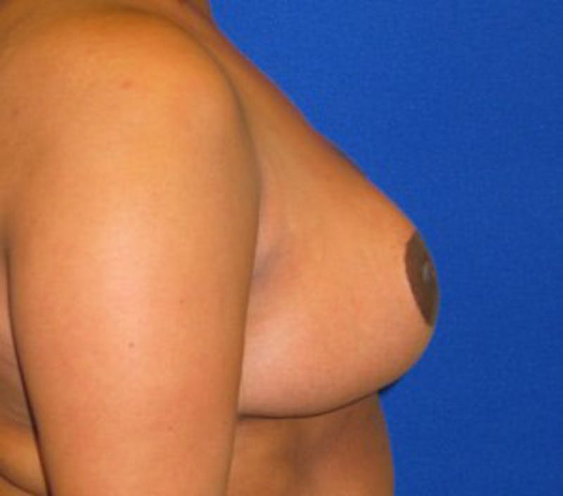 Reduction Before & After Gallery - Patient 175169635 - Image 4