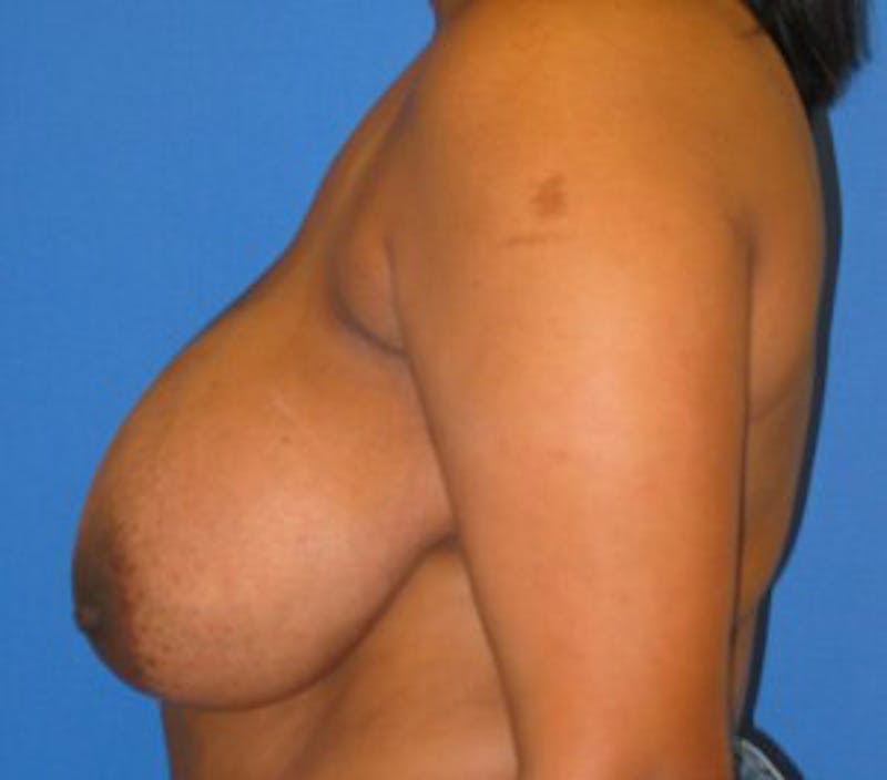 Reduction Before & After Gallery - Patient 175169635 - Image 5