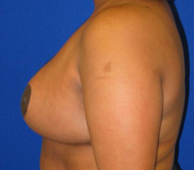 Reduction Before & After Gallery - Patient 175169635 - Image 6