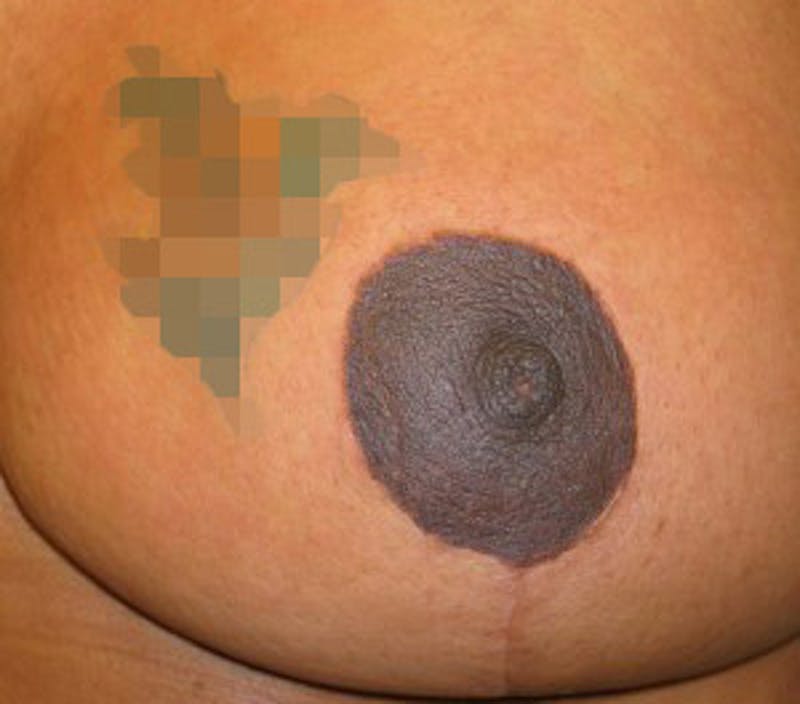 Reduction Before & After Gallery - Patient 175169635 - Image 8