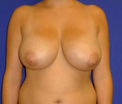 Reduction Before & After Gallery - Patient 175169643 - Image 1
