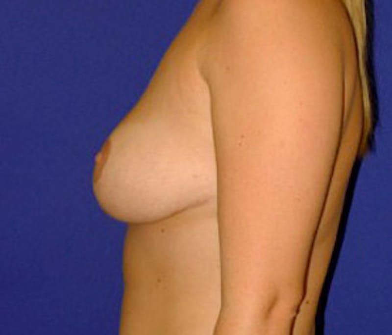 Reduction Before & After Gallery - Patient 175169643 - Image 4