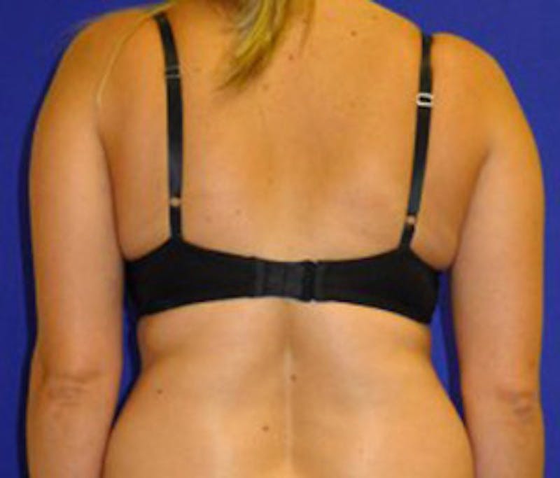 Reduction Before & After Gallery - Patient 175169643 - Image 5
