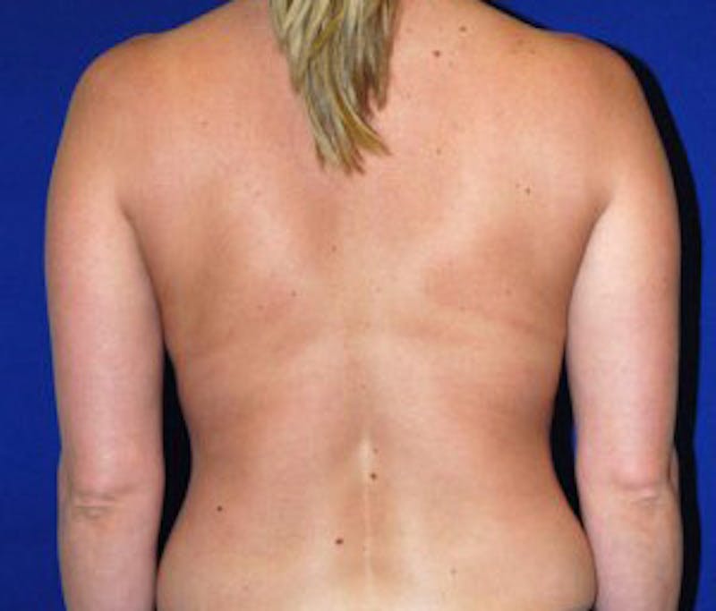 Reduction Before & After Gallery - Patient 175169643 - Image 6