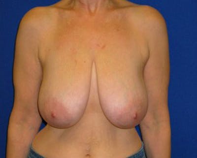 Reduction Before & After Gallery - Patient 175169648 - Image 1