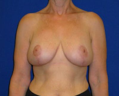Reduction Before & After Gallery - Patient 175169648 - Image 2