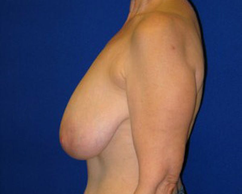 Reduction Before & After Gallery - Patient 175169648 - Image 5
