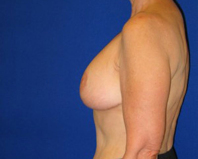 Reduction Before & After Gallery - Patient 175169648 - Image 6