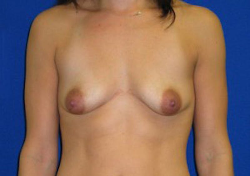 Augmentation Before & After Gallery - Patient 175169654 - Image 1