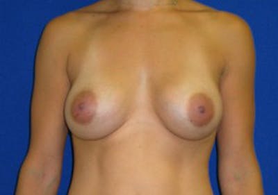 Augmentation Before & After Gallery - Patient 175169654 - Image 2