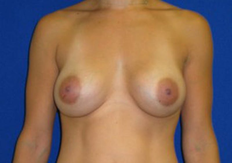 Augmentation Before & After Gallery - Patient 175169654 - Image 2