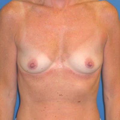 Augmentation Before & After Gallery - Patient 175169657 - Image 1