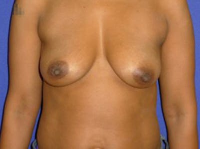 Augmentation Before & After Gallery - Patient 175169663 - Image 1
