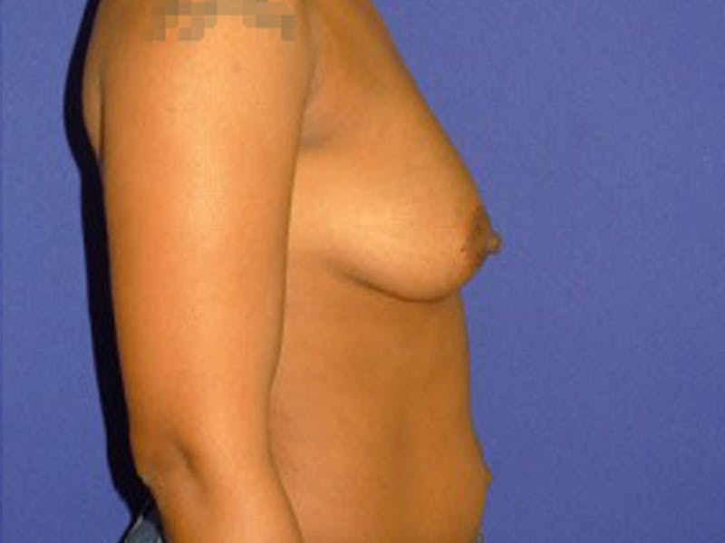 Augmentation Before & After Gallery - Patient 175169663 - Image 3