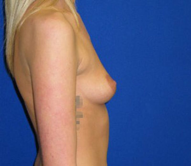 Augmentation Before & After Gallery - Patient 175169668 - Image 3
