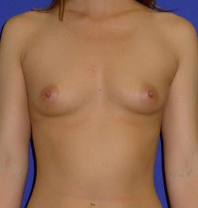 Augmentation Before & After Gallery - Patient 175169765 - Image 1