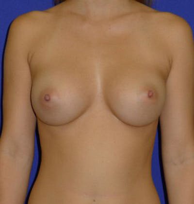 Augmentation Before & After Gallery - Patient 175169765 - Image 2
