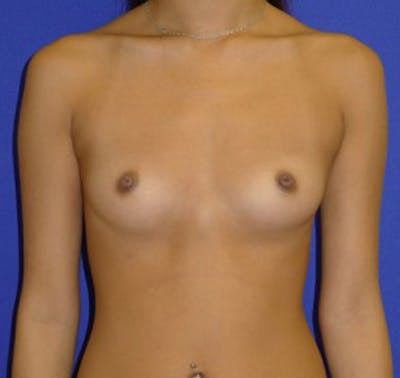Augmentation Before & After Gallery - Patient 175169766 - Image 1