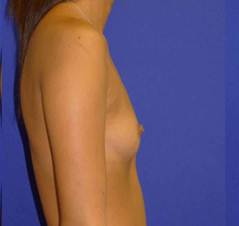 Augmentation Before & After Gallery - Patient 175169766 - Image 3