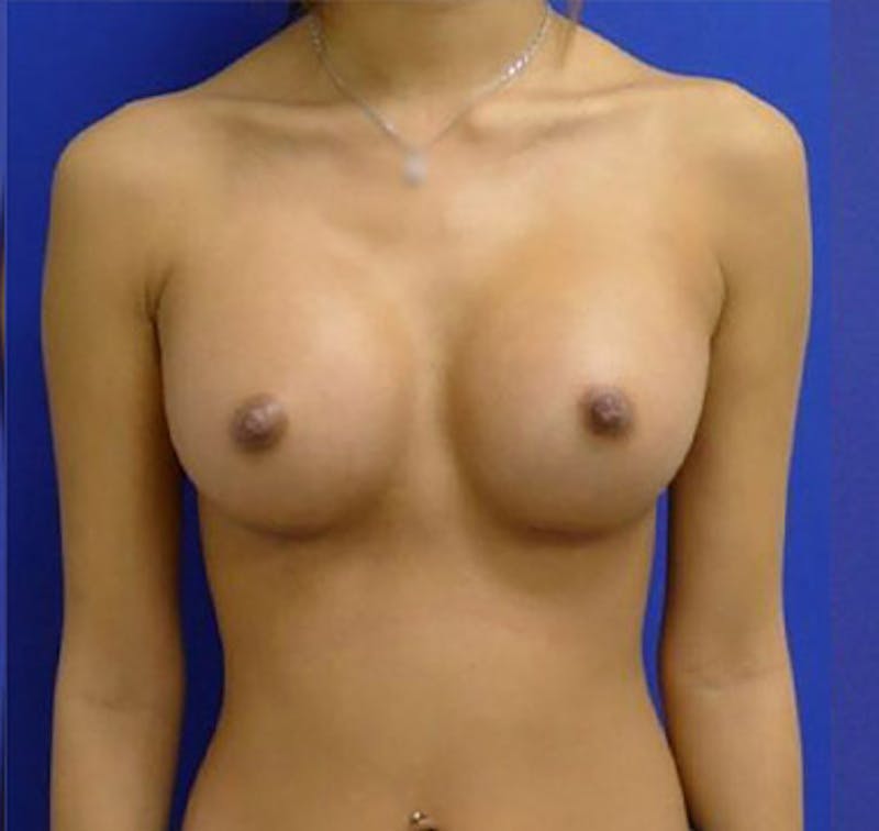 Augmentation Before & After Gallery - Patient 175169766 - Image 5