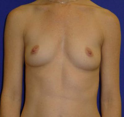 Augmentation Before & After Gallery - Patient 175169768 - Image 1