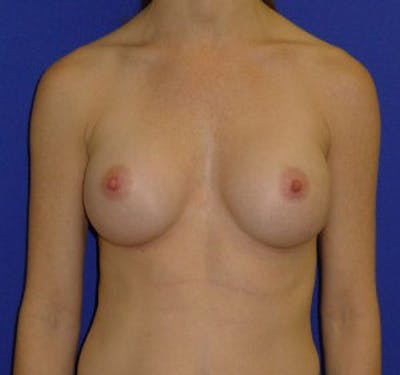 Augmentation Before & After Gallery - Patient 175169768 - Image 2