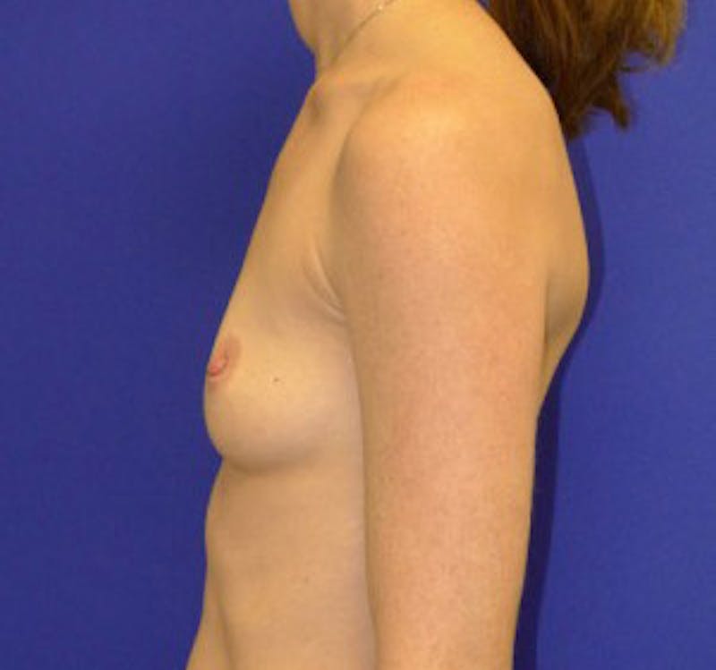 Augmentation Before & After Gallery - Patient 175169768 - Image 5