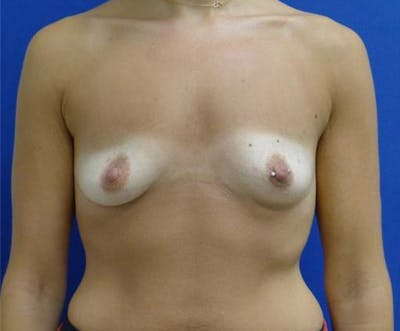 Augmentation Before & After Gallery - Patient 175169769 - Image 1