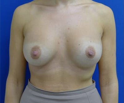 Augmentation Before & After Gallery - Patient 175169769 - Image 2