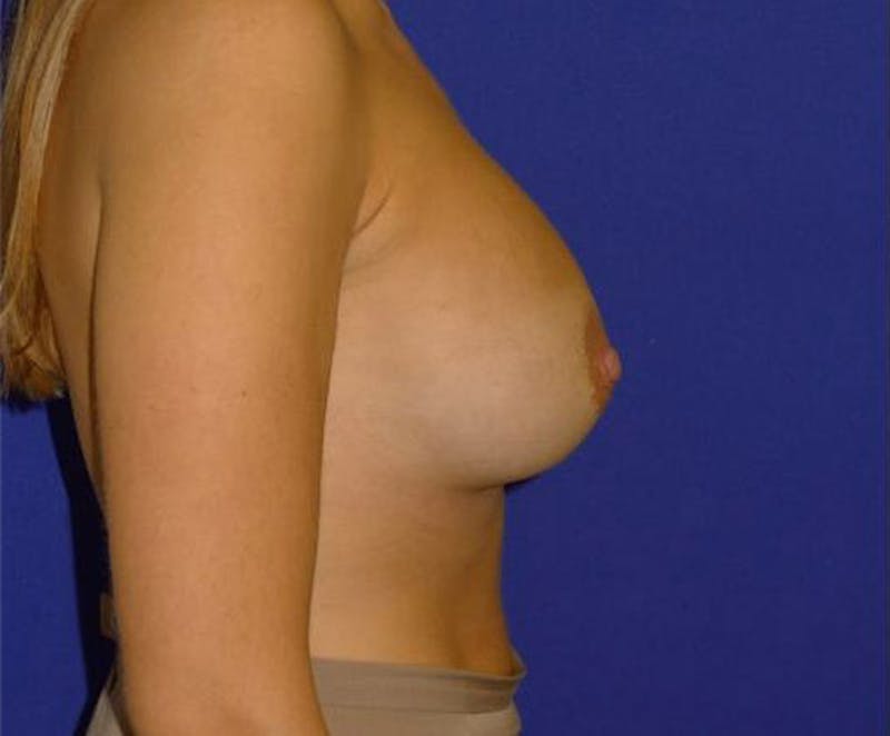 Augmentation Before & After Gallery - Patient 175169769 - Image 6