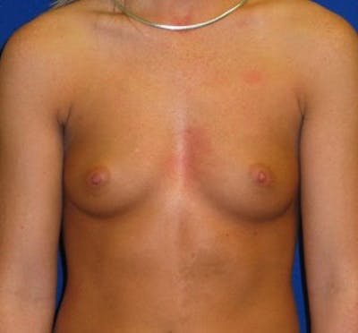 Augmentation Before & After Gallery - Patient 175169771 - Image 1