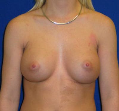 Augmentation Before & After Gallery - Patient 175169771 - Image 2