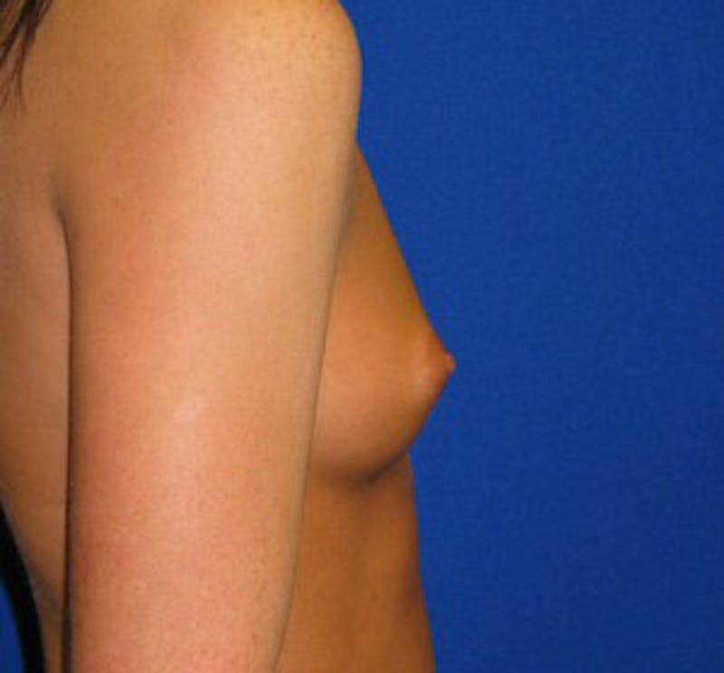 Augmentation Before & After Gallery - Patient 175169771 - Image 3