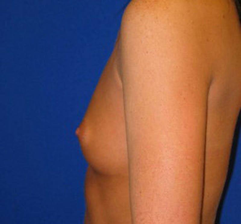 Augmentation Before & After Gallery - Patient 175169771 - Image 5