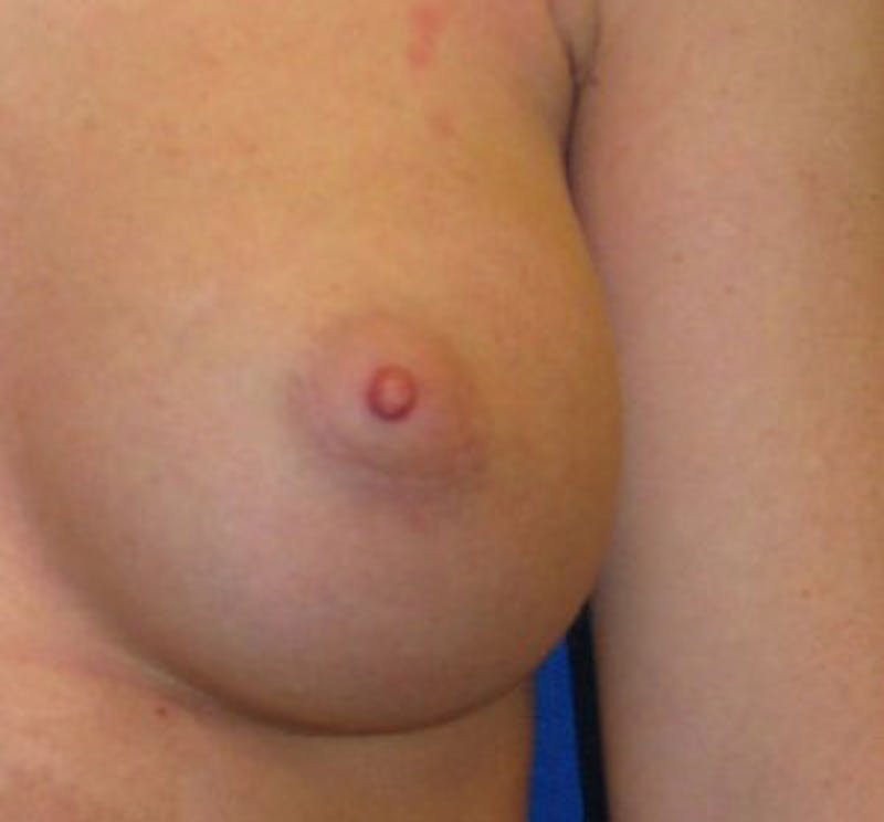 Augmentation Before & After Gallery - Patient 175169771 - Image 9