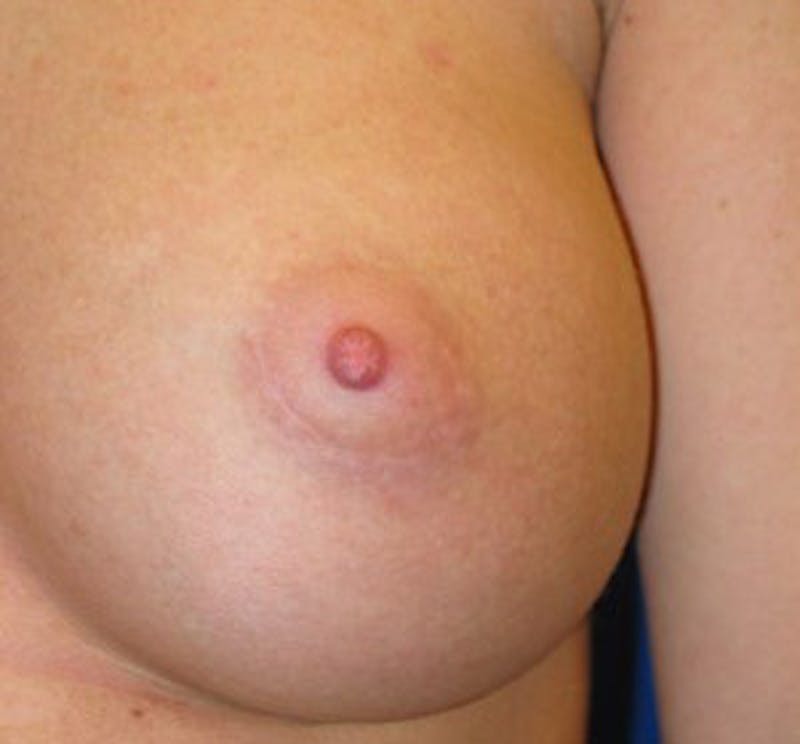 Augmentation Before & After Gallery - Patient 175169771 - Image 10