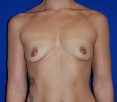 Augmentation Before & After Gallery - Patient 398425 - Image 1