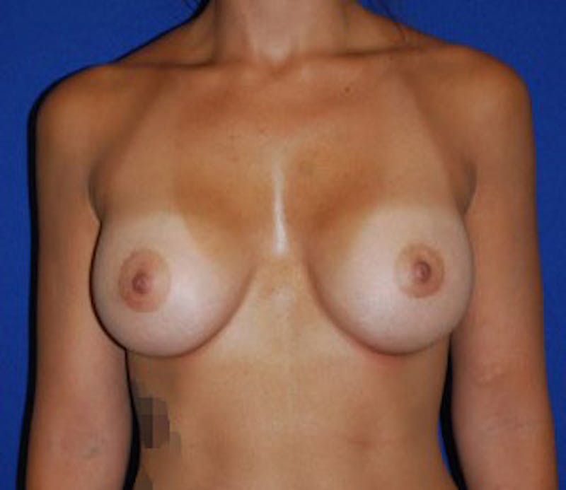 Augmentation Before & After Gallery - Patient 398425 - Image 2