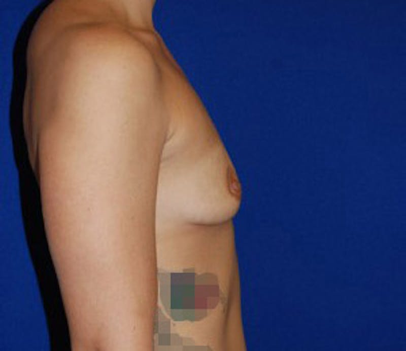 Augmentation Before & After Gallery - Patient 398425 - Image 3