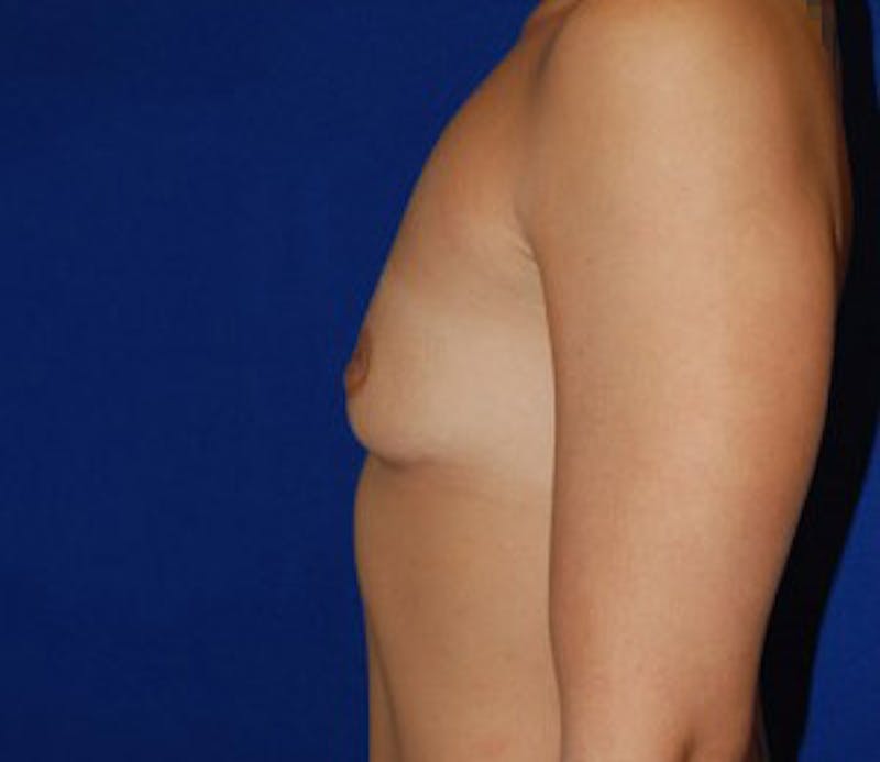 Augmentation Before & After Gallery - Patient 398425 - Image 5