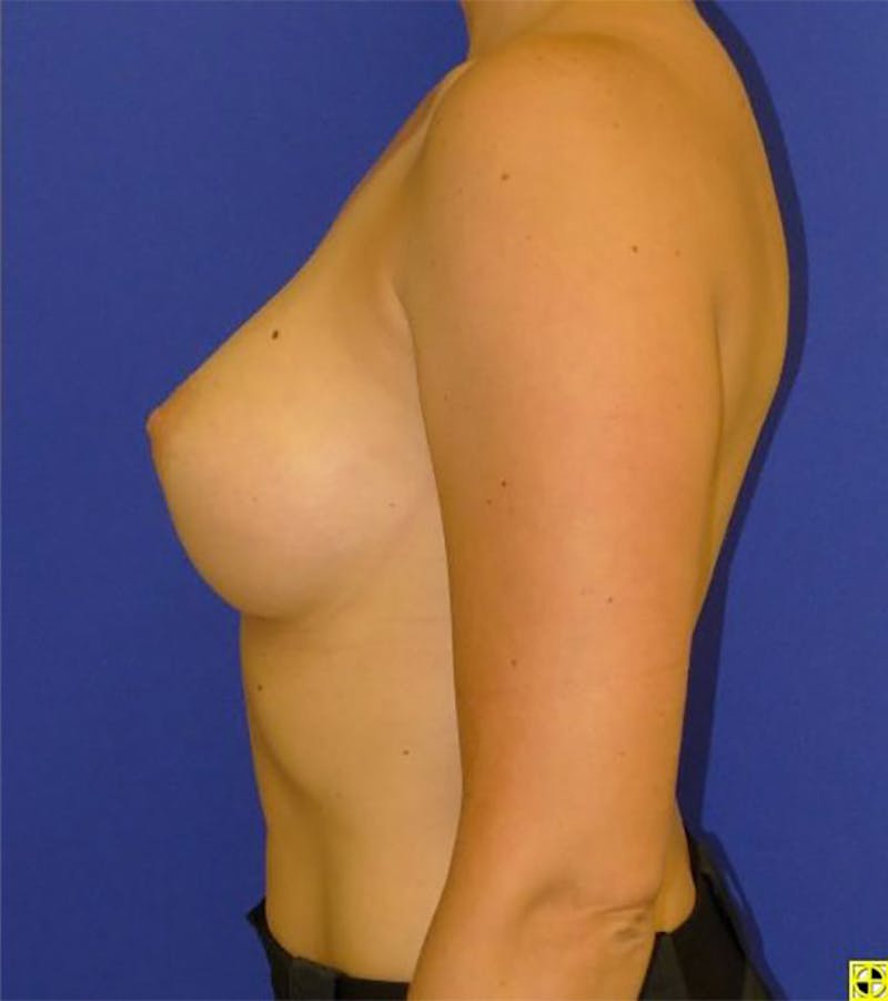 Augmentation Before & After Gallery - Patient 175169778 - Image 6