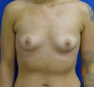 Augmentation Before & After Gallery - Patient 175169791 - Image 1