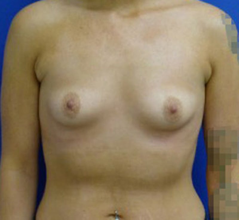 Augmentation Before & After Gallery - Patient 175169791 - Image 1