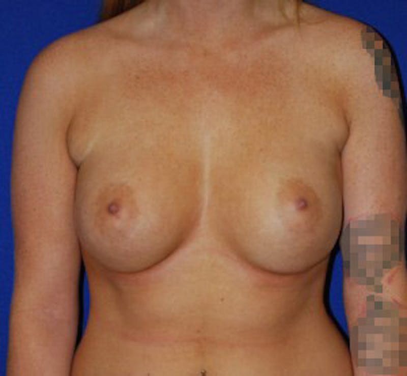 Augmentation Before & After Gallery - Patient 175169791 - Image 2