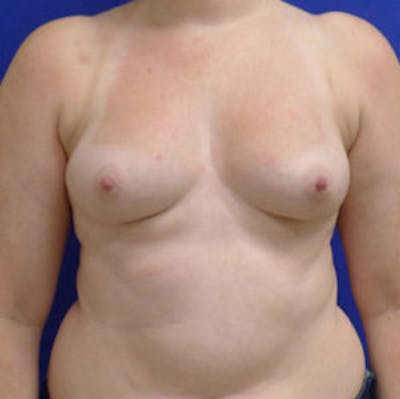 Augmentation Before & After Gallery - Patient 175169796 - Image 1