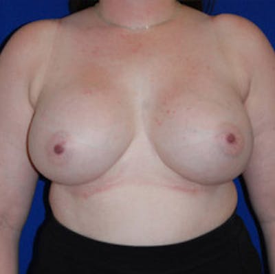 Augmentation Before & After Gallery - Patient 175169796 - Image 2