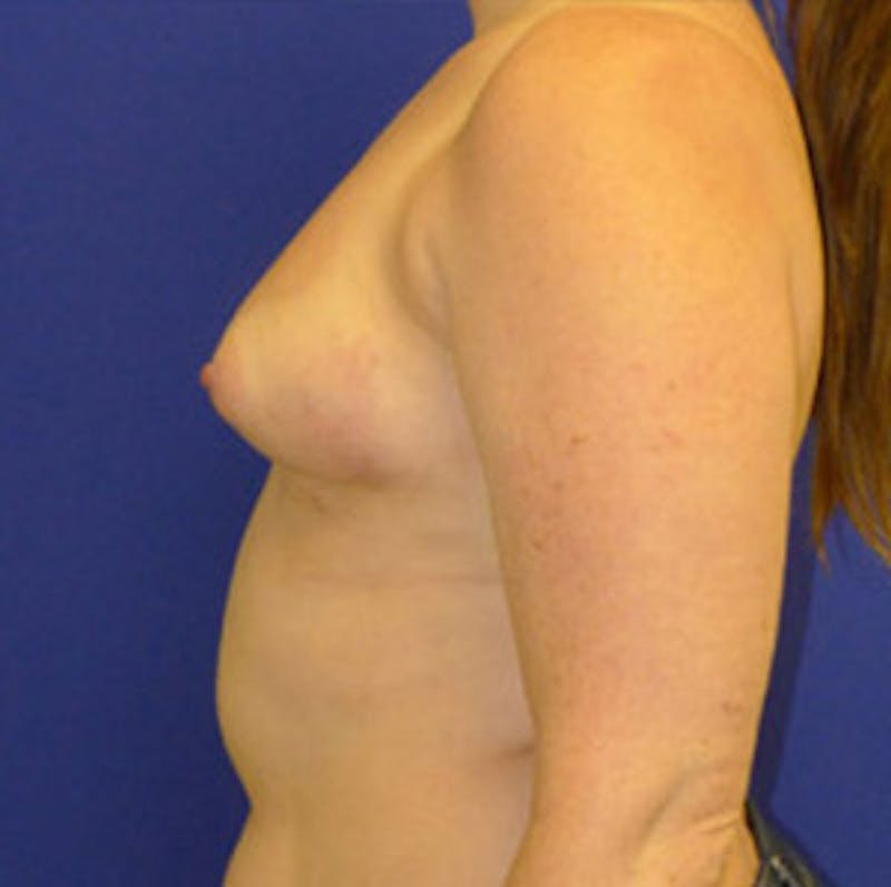 Augmentation Before & After Gallery - Patient 175169796 - Image 3