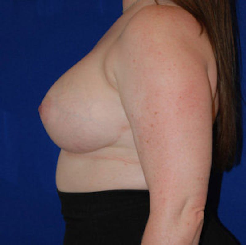 Augmentation Before & After Gallery - Patient 175169796 - Image 4