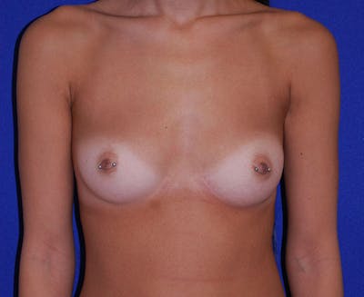 Augmentation Before & After Gallery - Patient 175169797 - Image 1