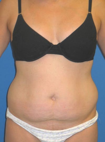 Abdominoplasty Before & After Gallery - Patient 175173254 - Image 1